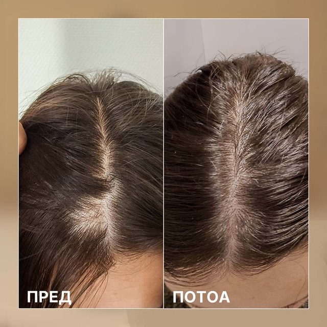 BIOELIXIR-SCALP----prije-posle---MK