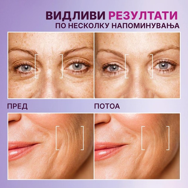 BOTOX---PRIJE-POSLIJE--MK