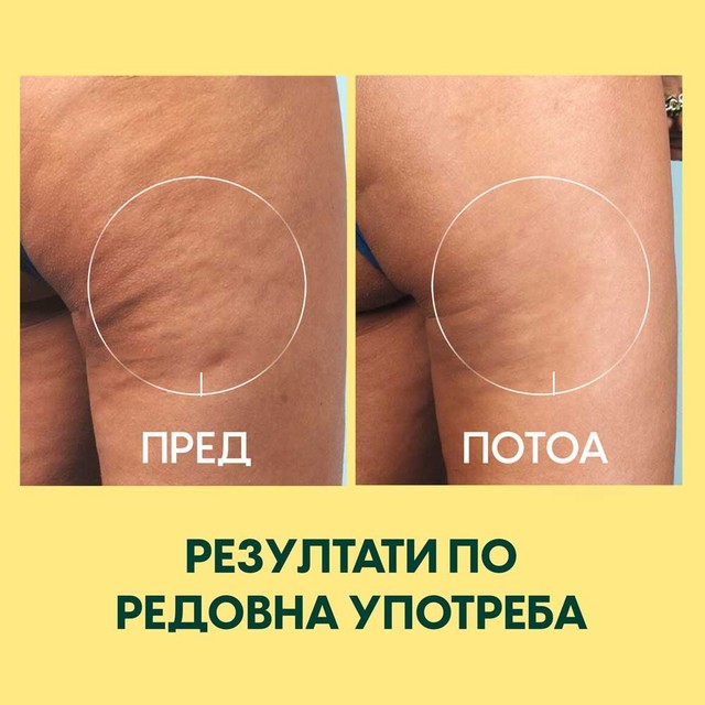 ANTICELULIT-SET--PEIJE-POSLE